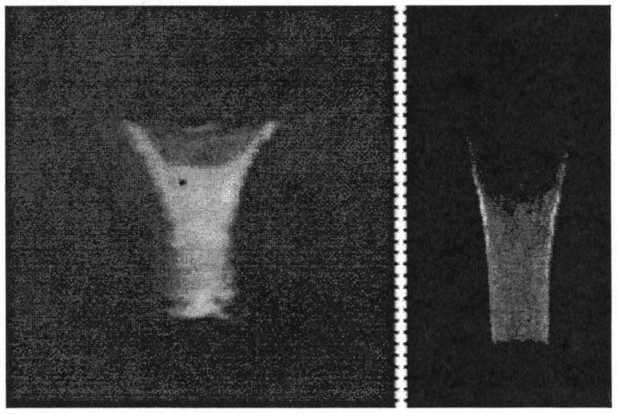 Fig. 5. Conical inflow of a current conducting plasma column. The flow is from top to bottom with striations in the body of the column, and the beginning of a plasma feature at top-center. These experimental photographs pertain to a 5 MV, 3 MA plasma.